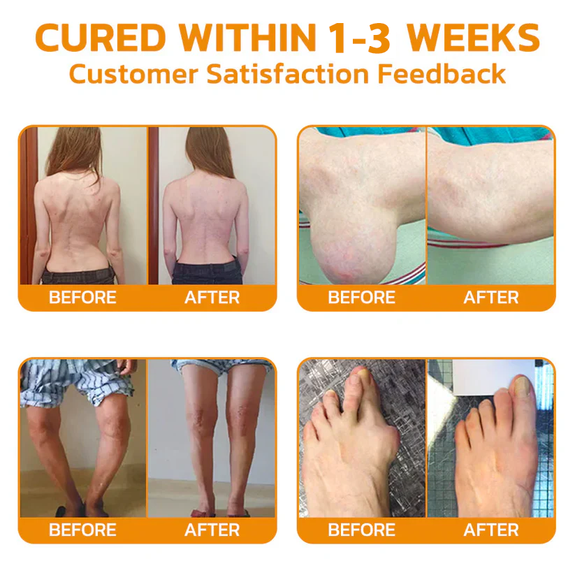 ✅Official Store: flysmus™ Bee-Venom Pain-Relief Bone Healing Cream👨⚕️USA Osteopathic Medical Association (AAOS)Approved(Reducing joint swelling, pain, stiffness, redness, warmth, soreness, and joint fatigue)