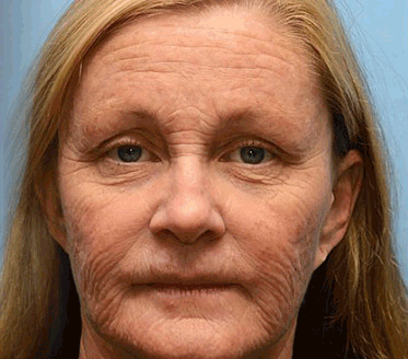 🐝🌳Made and Shipped from USA✨Furzero™ Botox Bee Venom Wrinkle Removal Cream-🔥LAST DAY 70% OFF