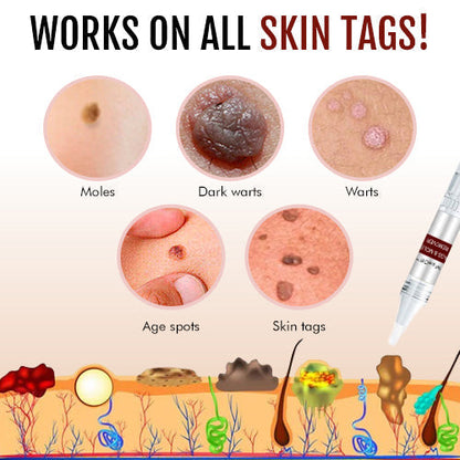 🎁BUY 1 GET 1 FREE🎁 Seurico™ Tags & Moles Remover